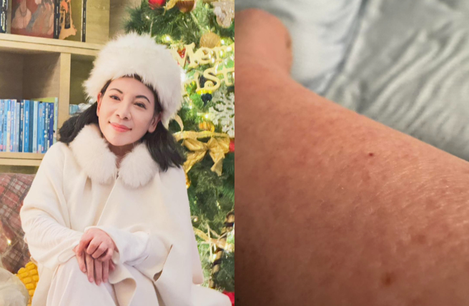 陈文茜接受免疫治疗后，坦言几乎体无完肤。（图／脸书 文茜的世界周报 Sisy's World News）