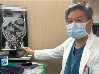 爛牙害腸阻塞！5公分香菇卡小腸釀禍