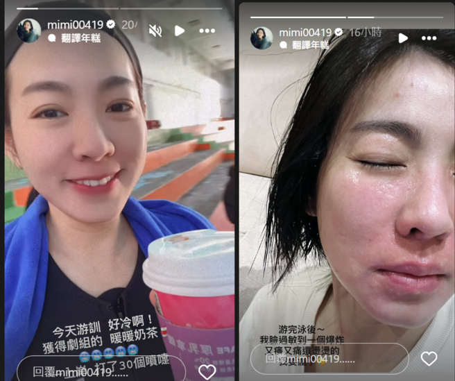 米可白透露自己因为过敏整张脸红肿。（图／翻摄自米可白IG）