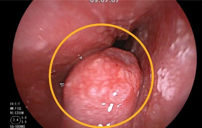 南投县年约60岁妇人不菸不酒，月前至卫福部南投医院回诊，发现罹患食道癌第1期。（南投医院提供／杨静茹南投传真）