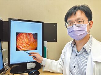 年節聚餐放縱吃 小心大腸憩室