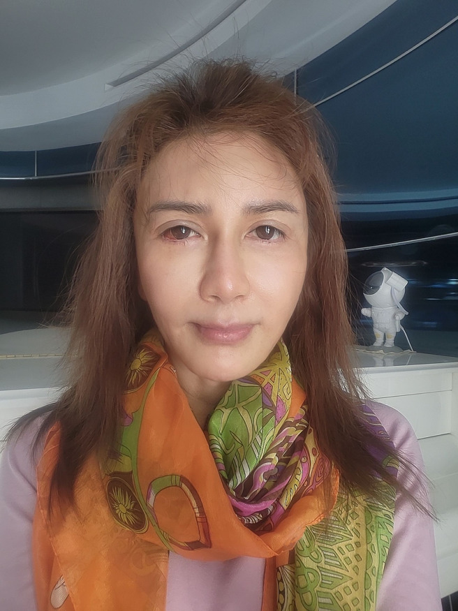 王瀞文术后5天眼睛恢復正常。（图／王瀞文脸书）