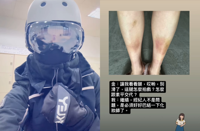 天心滑雪惊传摔倒意外，双腿大片瘀青伤势曝光。（图／IG@skyheart1111）