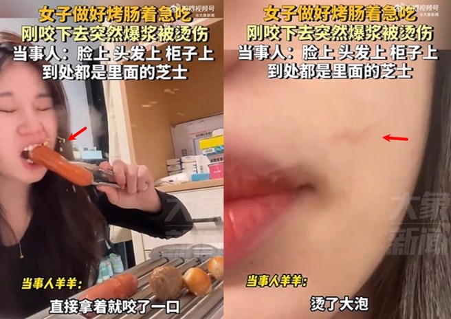 女子在家吃烤腸，咬下去熱油爆出，臉跟嘴都被燙傷。（圖／翻攝微博）
