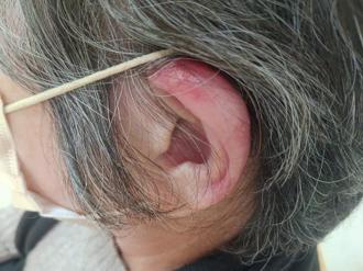 婦人連嗑3天薑母鴨羊肉爐 牙齦、耳紅腫 醫曝1菜可緩解