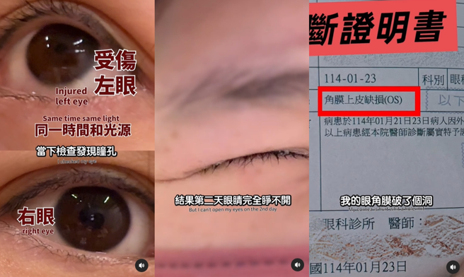 Ashly被髮夹钝角戳到眼睛，就医后诊断为「角膜上皮缺损」。（图／翻摄自ashlychan0113 IG）