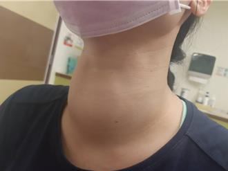 20多岁就长「大脖子」！她靠微创手术重拾自信