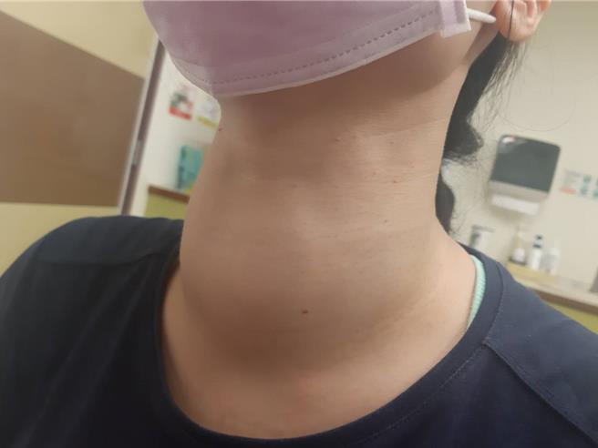 蔡女罹患甲狀腺機能亢進，脖子腫大。（彰化醫院提供／葉靜美彰化傳真）