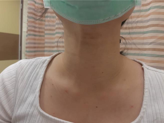 蔡女罹患甲狀腺機能亢進，脖子腫大，手術後恢復原本外觀。（彰化醫院提供／葉靜美彰化傳真）