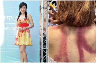 姚黛玮背部全裸「惊见大片瘀血」 自爆阴阳失调：被摧残成这样