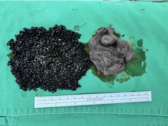 女吃火鍋突腹痛  醫切開膽囊驚見「爆漿魚子醬」