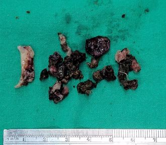 鼻子飄腳臭味 醫清出整盤「發黴屎塊」：塞爆了