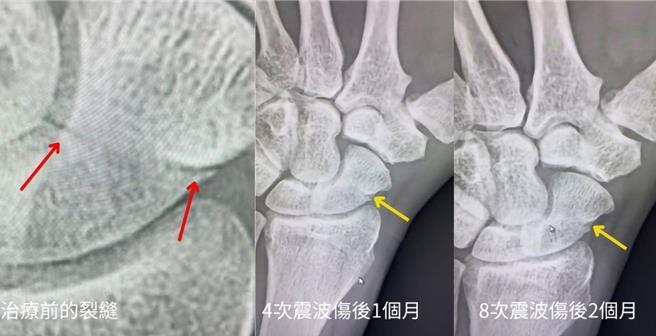 高雄一名47岁吊车驾驶因跌倒，导致右手舟状骨骨折。（院方提供／纪爰高雄传真）