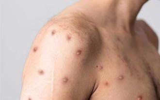 今年首起境外移入M痘 30多歲男泰國返台後發病