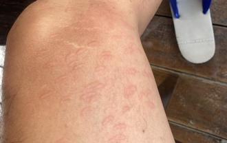 獨家》高雄美濃小黑蚊大爆發 戶外站2分鐘變「紅豆冰」