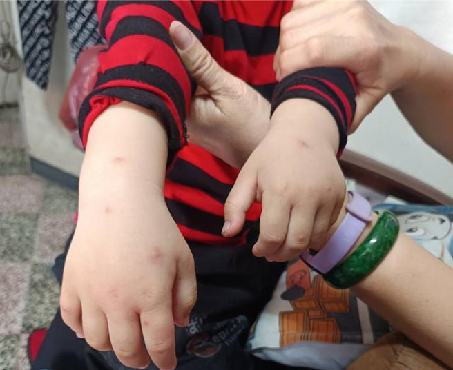 美浓居民邱先生心疼地说，看见2岁半的孙子全身被叮得满是红点，尤其头部、手部肿胀严重，让他十分担忧。（林雅惠摄）