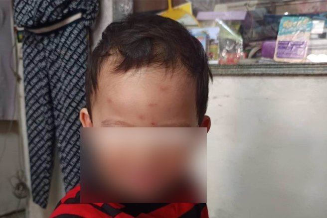 美浓居民邱先生心疼地说，看见2岁半的孙子全身被叮得满是红点，尤其头部、手部肿胀严重，让他十分担忧。（林雅惠摄）