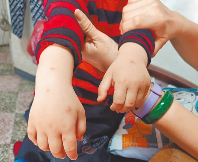 美浓居民邱先生说，看见2岁半的孙子全身被叮得满是红点，尤其头部、手部肿胀严重，让他十分担忧。（林雅惠摄）