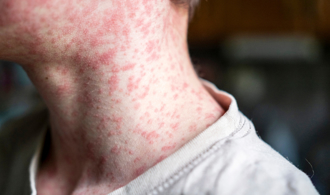 桃園首例本土麻疹個案 曾接觸境外移入者、到過1遠傳門市