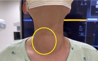 4旬男頸部不適吞嚥有異物感 罹患甲狀腺結節靠1招治療 免開刀