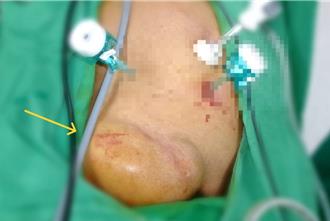 7旬翁右下腹「鼓一包」腹痛求醫 竟是罕見雙疝氣