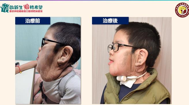 周小弟使用口服标靶治疗后，3个月内肿瘤就明显缩小，也不再需要24小时靠呼吸器过活，终于有机会全家出国旅游。（阳光社会福利基金会提供／林周义台北传真）