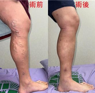 「蚯蚓」爬上腿！警察静脉曲张缠身 靠1手术远离酸麻肿