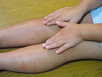 不可輕忽！麻疹現蹤台灣 嚴重併發症恐致死