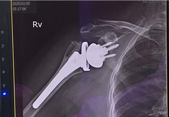 7旬婦肌腱斷裂、肱骨壞死 肩痛到無法拿筷子 靠1手術重拾健康