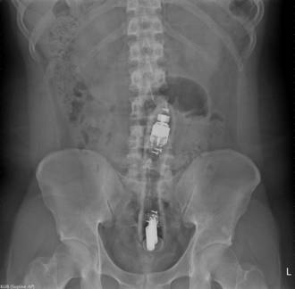 男震肛一整晚 醫一夾驚見20cm巨棒：還在動 