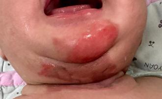 爸媽自製熱水蒸氣治鼻塞 滿月嬰臉脖大面積燙傷 醫曝正確方法