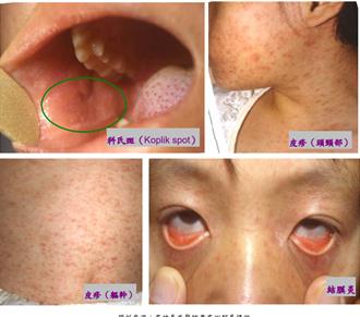 全球麻疹疫情升溫 衛生局曝確診症狀：連假出國要打疫苗