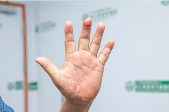 6旬農夫不慎削指深可見骨 醫師用「埋指養指」術保中指