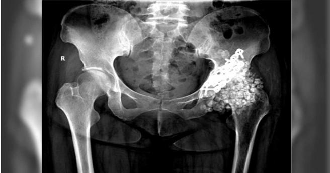 王女說， 「髖關節裡像被灌入泥沙，每走一步都像在碎石堆裡挪動。」（圖／翻攝自福州晚報）