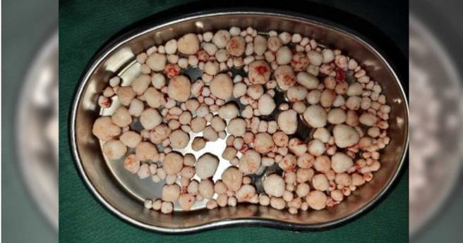 王女及時就醫治療，並經手術從身體裡取出多達259顆軟骨瘤。（圖／翻攝自福州晚報）