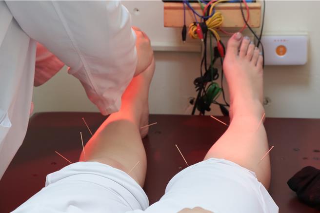 患者進行相關穴道針灸。（彰化醫院提供／葉靜美彰化傳真）