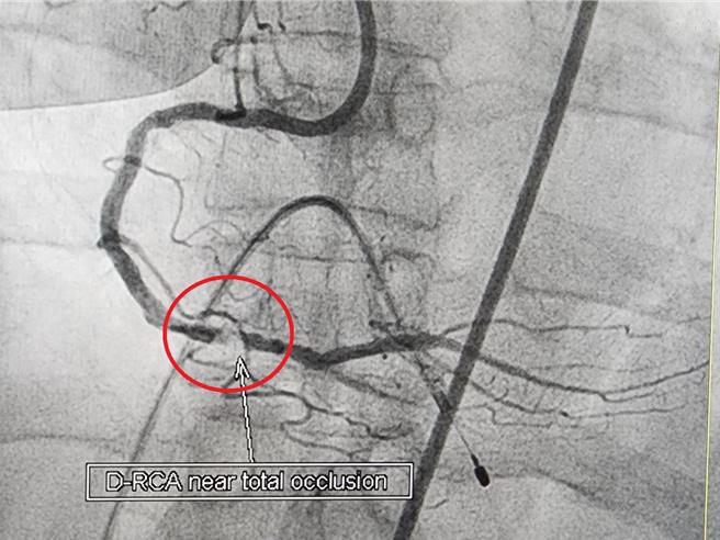 邱女士的右冠状动脉钙化严重狭窄（红圈处），一般导管气球无法通过处理。（大千医院提供／吕丽甄苗栗传真）