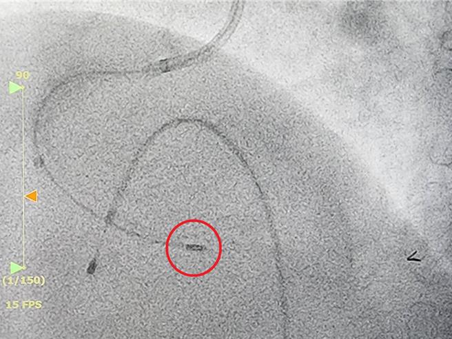 冠状动脉旋磨术使用高速旋转的金刚石包覆钻头（红圈处），磨除血管内的钙化斑块。（大千医院提供／吕丽甄苗栗传真）