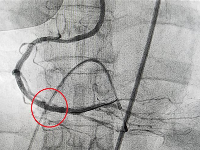 邱女士在接受治疗后，原本钙化严重的病况获得良好的改善（红圈处）。（大千医院提供／吕丽甄苗栗传真）