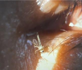 「眼內卡蚊」3天險失明 醫抓出來驚喊：還在拍翅膀