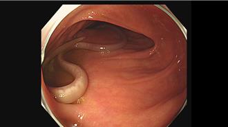 影》猪粪种菜！ 妇肚胀暴瘦 医惊：养出2条20cm胖蛔虫