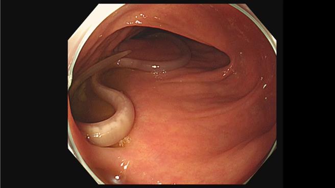 大肠镜检查，赫然在患者乙状结肠发现两条白色蠕虫不停蠕动。（大林慈济医院提供／吕妍庭嘉义传真）