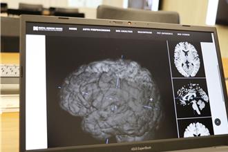 精神病診斷不靠猜！陽明交大攜手北榮 AI影像看見大腦病灶