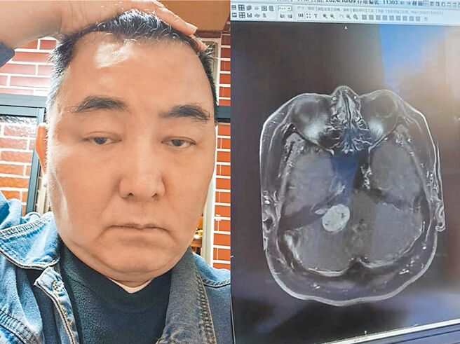 資深演員徐亨腦瘤引發水腦症，長期使用藥物導致月亮臉、身體肥大水腫。（摘自徐亨臉書）