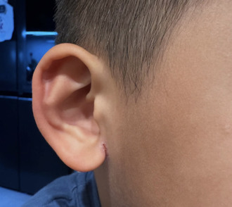 林可彤儿耳朵裂开达半年 医细看眼下细线：母子3人都中