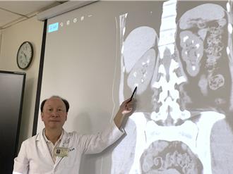 婦2年5度結石雙腎「滿天星」  醫揪出主因