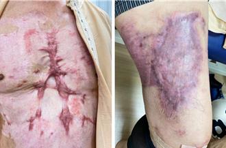 3年129人因瓦斯氣爆嚴重燒傷 陽光基金會籲強化3大防線