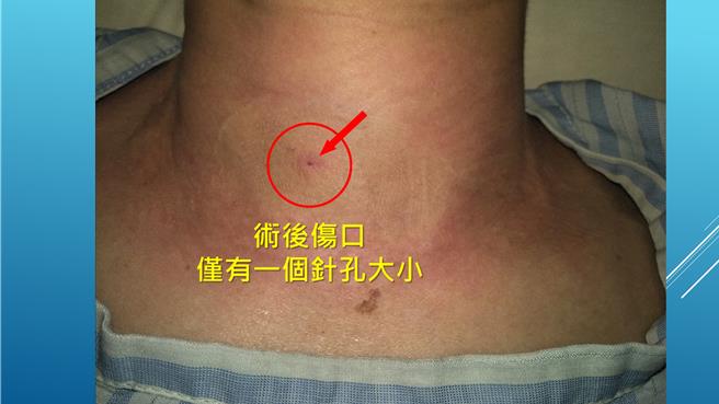 头颈肿瘤消融术手术时间较短、伤口更小。（院方提供／李京升台中传真）