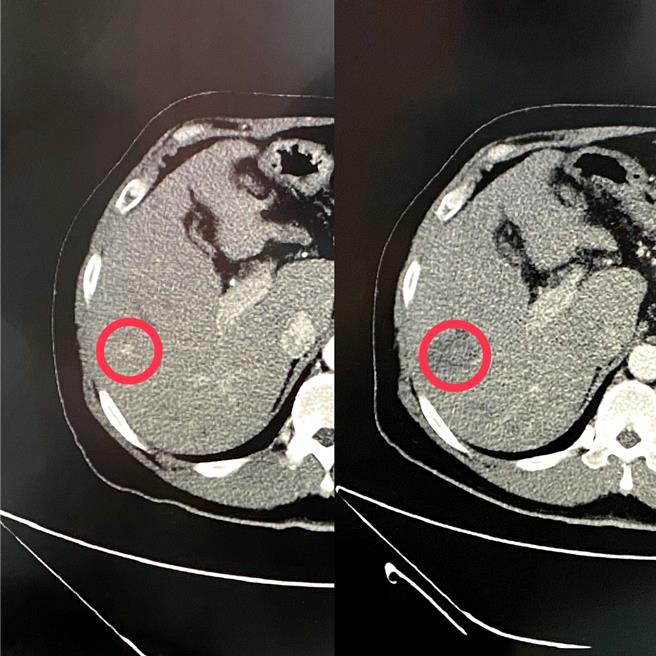 透过电脑断层扫描可见病患术前有0.5公分肿瘤（左图），给予微创射频消融术治疗后肿瘤已消失（右图）。（图／台中荣总）