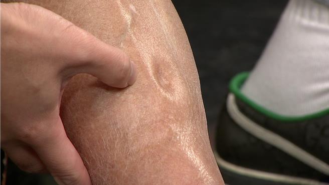 孔锵右脚不明原因的肿胀。（年代提供）